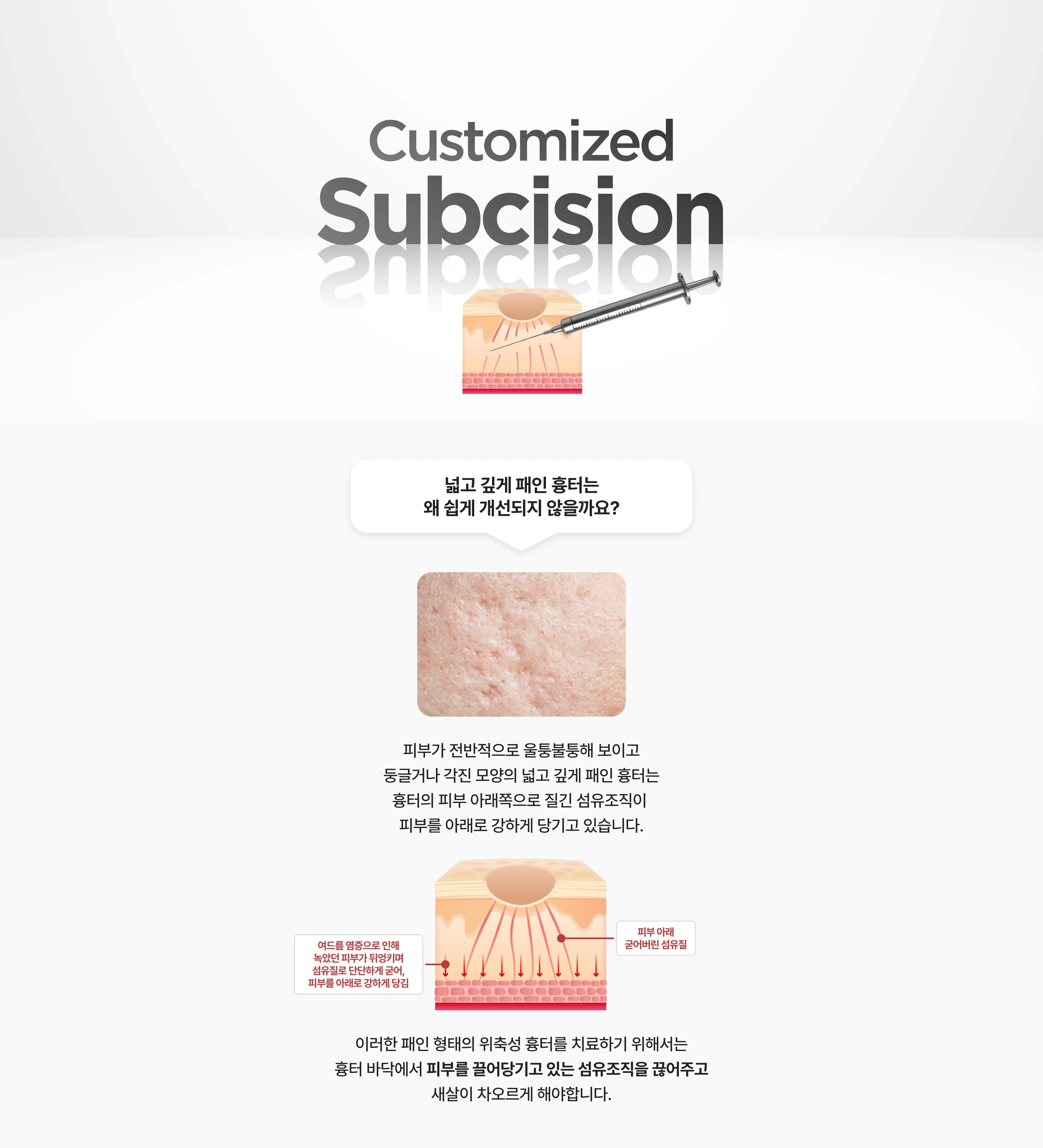 Subcision